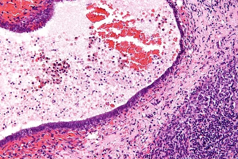 Ananda Pharma Cleared to Begin Dosing in NHS-Backed CBD Endometriosis Trial